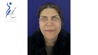 لیفت صورت (جوانسازی صورت)
