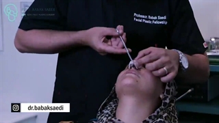 گچ بینی تو خودت میتونی برداری ؟!