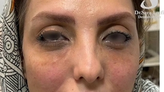 چقدر تغییر با فیلر