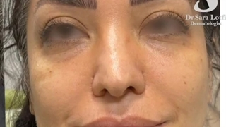 تغییر صورت در یک جلسه بدون بی هوشی