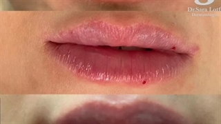 چه لب طبیعی