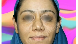 نمونه کار قبل و بعد جراحی بینی