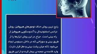 حذف تومور هیپوفیز