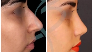 نمونه هایی از جراحی نچرال رینوپلاستی