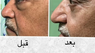 رفع پف ریز چشم