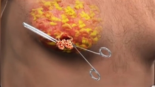 ژینکوماستی چیه؟