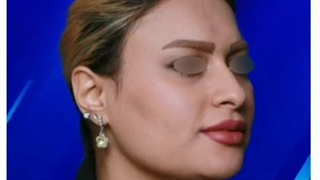 نمونه کار جراحی بینی