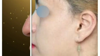 نمونه جراحی زیبایی بینی