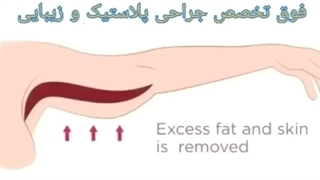 دیگه بازو افتاده نیست