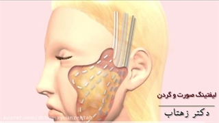 چجوری لیفت صورت انجام میشه؟