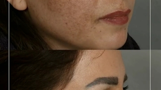 درمان لک صورت پروتز دندان