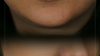 تزریق فیلر چانه و لب