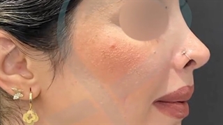 نتبجه واقعی بعد از جراحی بینی