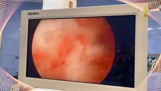 مروری کوتاه بر هیستروسکوپی پولیپ رحمی 