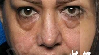 بلفاروپلاستی 4 پلک