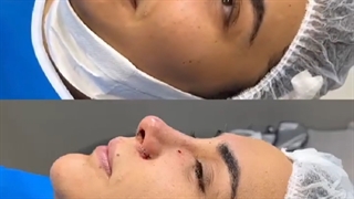 بینی های استخوانی که زیاد پهن نیستند و بیشترین مشکل انها در قسمت نوک بینی و سوراخها هست