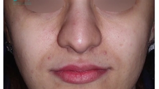 جراحی زیبایی بینی گوشتی به صورت طبیعی