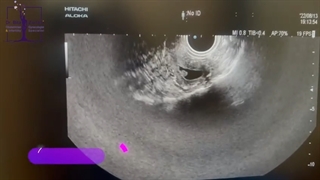 سونوگرافی رحم با پولیپ