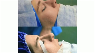 بلافاصله بعد از عمل بینی و نتیجه بعد از عمل 