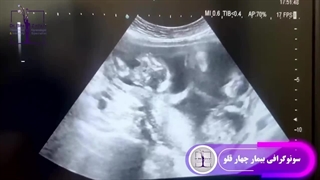 سونوگرافی چهارقلوها