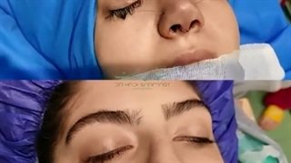 بلافاصله بعد از جراحی بینی با انحراف شدید !!! 