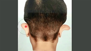 گوش های برجسته دارید و از فرم آن ها ناراضی هستید ؟