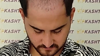 کاشت مو با روش میکرو sut در کلینیک vip تهران