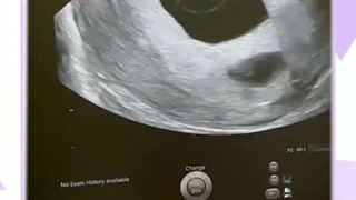 بارداری موفق مامان خوش اخلاق ‌✔️ بعد از یازده سال نازایی ▪️▪️▪️