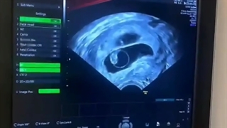 بارداری دوقلویی بعد از چهار سال انتظار 