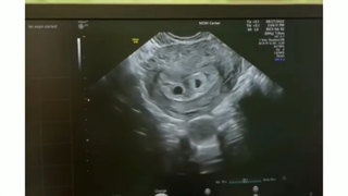 بارداری با مشکل نازایی همسر (آقا)