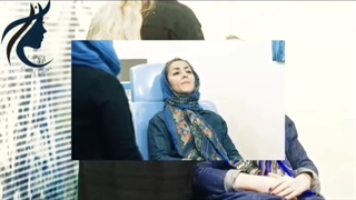 تزریق فیلر خط خنده  و بوتاکس