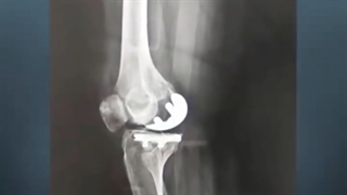 تعویض مفصل نیمه زانو چیست؟