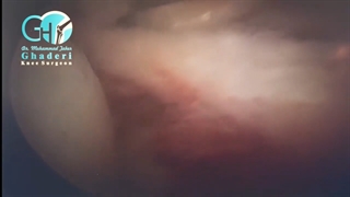 جراحی رباط صلیبی پاره شده به چه شکل هست؟