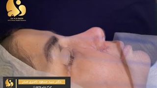 فیلم واقعی جراحی بینی در اتاق عمل!
