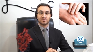 همه چیز در مورد بیماری پسوریازیس
