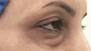 جراحی حذف چربی زیرچشم
