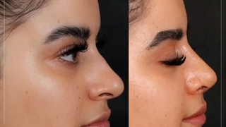 جراحی رینوپلاستی کاملا طبیعی