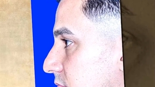 جراحی بینی مردانه