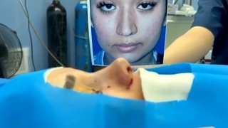 عمل جراحی بینی