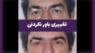 پف چشم