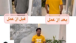 تعویض مفصل در شکستگی استابولوم