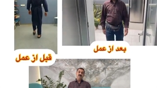 جوانی با بیماری روماتیسمی از نوع لوپوس که به علت سیاه شدن سراستخوان ران به علت کورتون تحت عمل تعویض مفصل دو طرفه