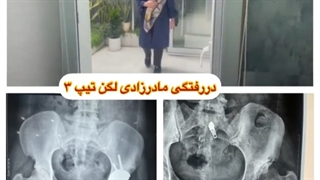در رفتگی مادرزادی لگن تیپ 3