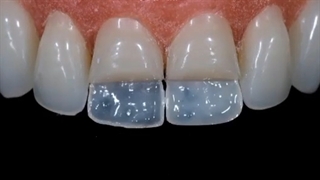 سبحان دنتال کامپوزیت