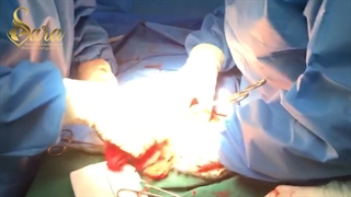 جراحی هیسترکتومی