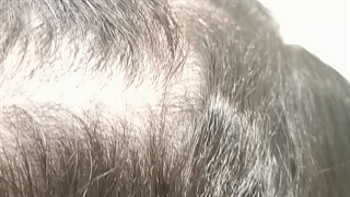 مزوتراپی مو