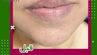 تزریق فیلر لب