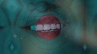 لمینت یا کامپوزیت؟ کدام یک برای اصلاح طرح لبخند بهتر است؟