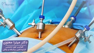 فتق جدار شکم : لاپاراسکوپی یا عمل باز ⁉️