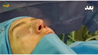 جراحی رینوپلاستی مردانه کاملا طبیعی